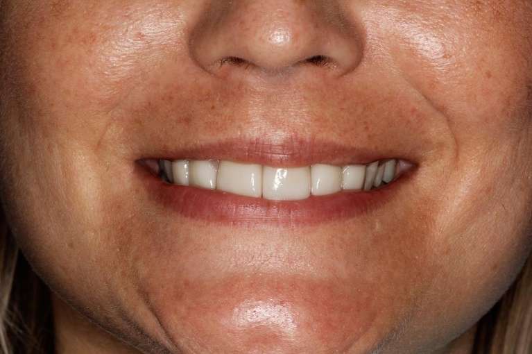 White womens mouth after porcelain crowns, huntsville al