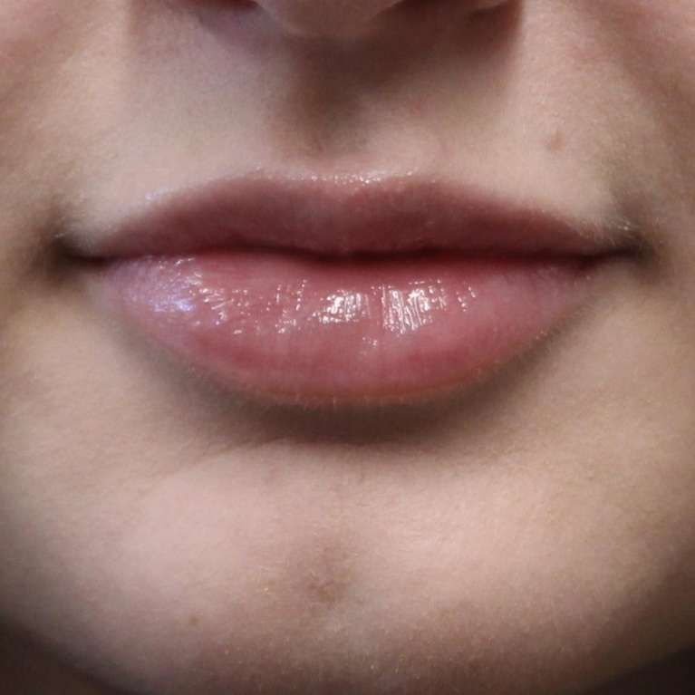 Womens lips after lip enhancement, huntsville al