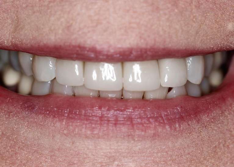 Womens mouth after porcelain crowns, huntsville al