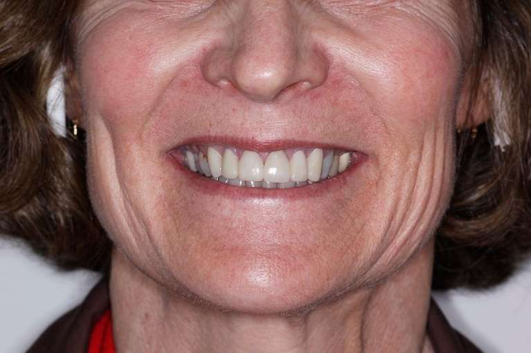 Older womans mouth after porcelain crowns, huntsville al