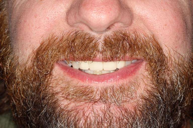 Close up of mans mouth after replacing missing front tooth with an implant, huntsville al