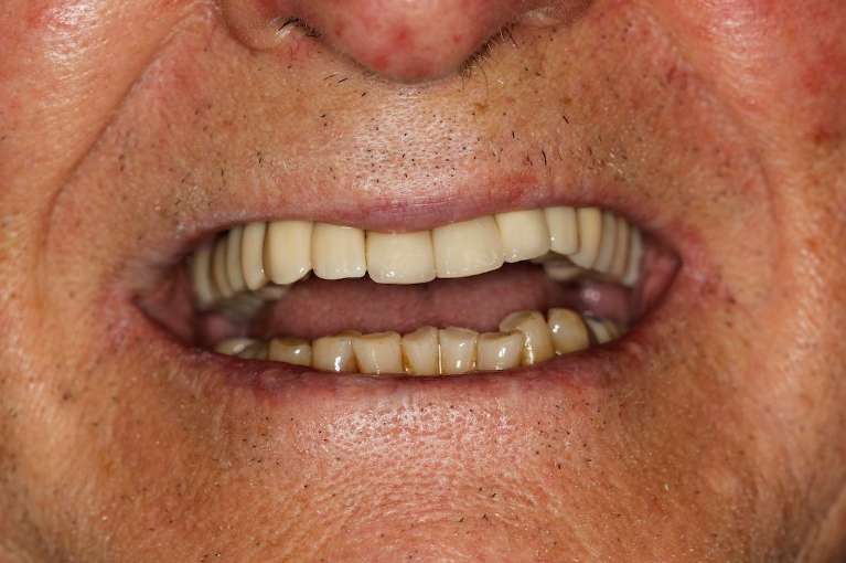 Replacing-Missing-Teeth-With-Dental-Implants-After-Image
