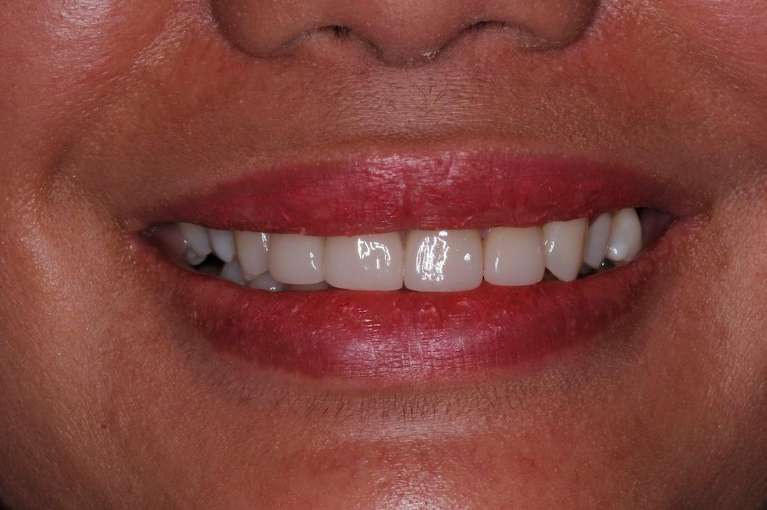 Womens mouth after veneers, huntsville al