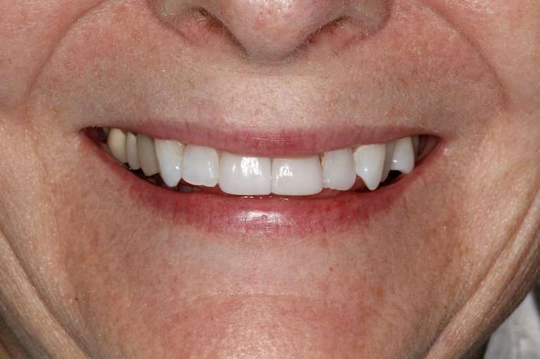 Close up of older womens mouth after veneers, huntsville al