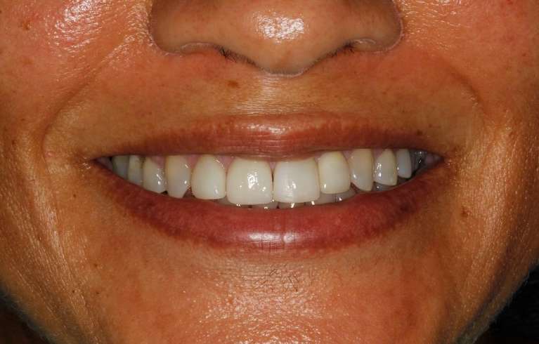Womans full mouth after veneers, huntsville al