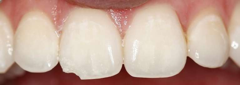 Close up view of teeth before bonding repair, huntsville al