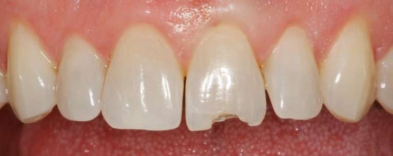 Front teeth before bonding repair, huntsville al