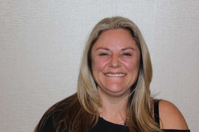 Woman before botulinum toxin facial smoothing, huntsville al