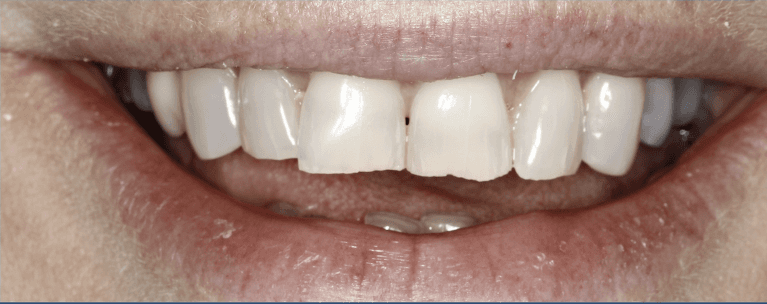 Close up of womans mouth before ceramic crowns, huntsville al