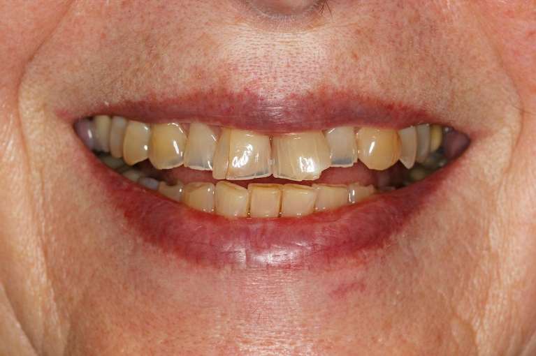 Close up of older womans mouth before ceramic crowns, huntsville al