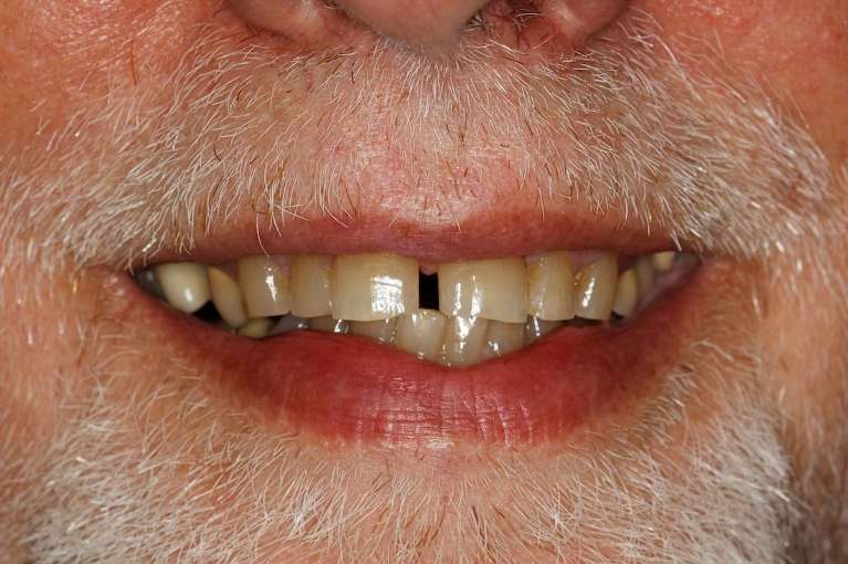 Older man with goatee before ceramic crowns, huntsville al