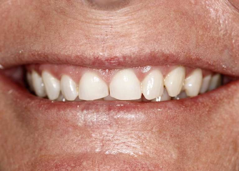 Close up of mouth before ceramic veneers, huntsville al