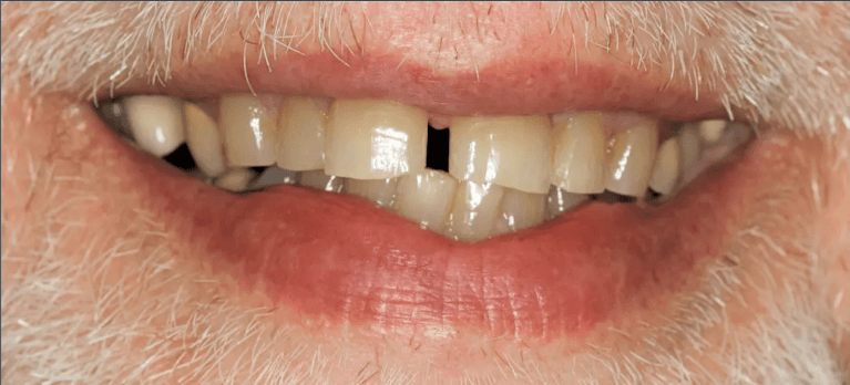 Mans mouth before closing spacing via ceramic crowns, hutnsville al
