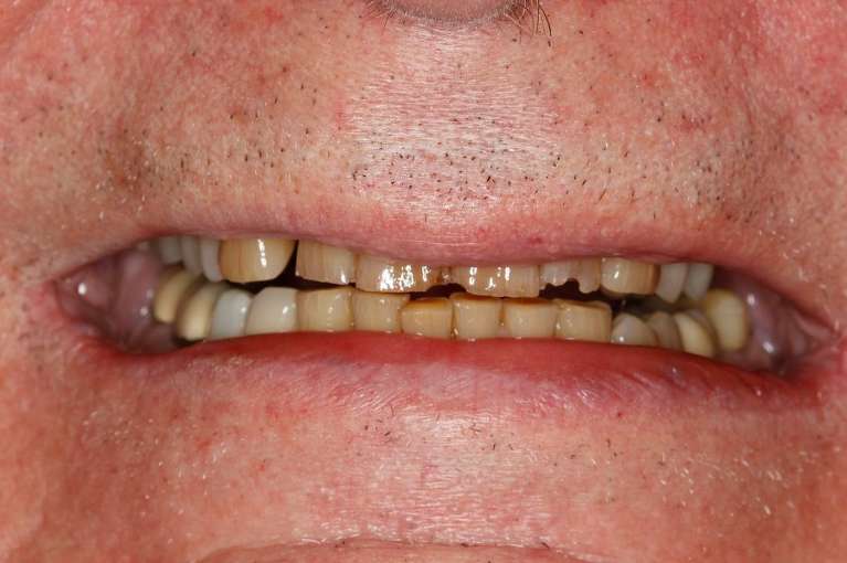 Mans mouth before crowns, huntsville al