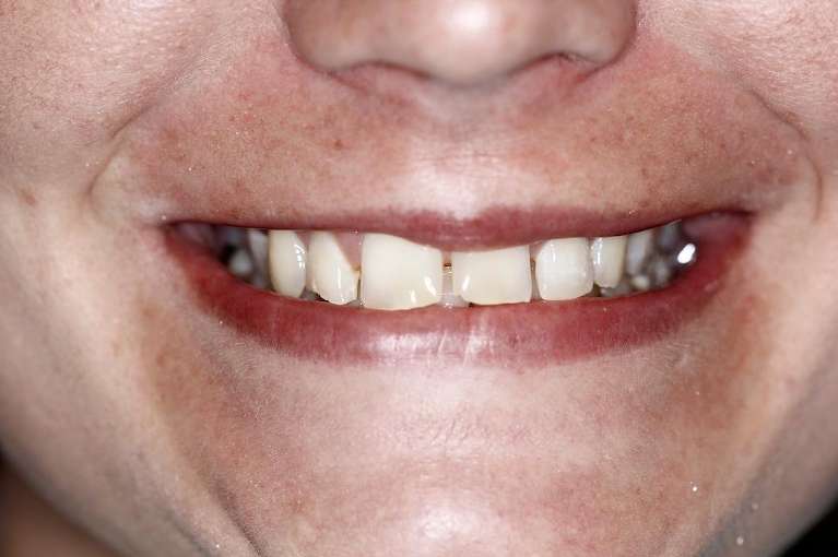 White womens mouth before porcelain crowns, huntsville al