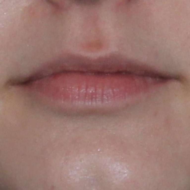 Womens lips before lip enhancement, huntsville al