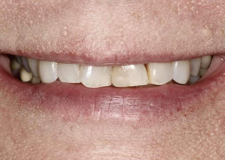 Womens mouth before porcelain crowns, huntsville al