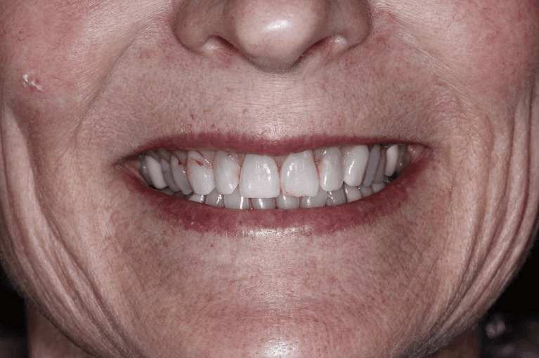 Older womans mouth before porcelain crowns, huntsville al