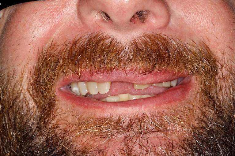 Close up of mans mouth before replacing missing front tooth with an implant, huntsville al