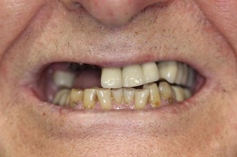 Replacing-Missing-Teeth-With-Dental-Implants-Before-Image