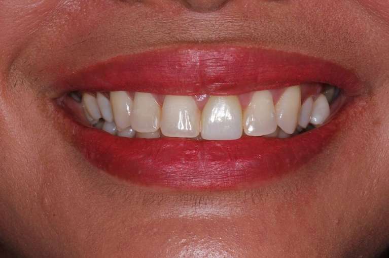 Womens mouth before veneers, huntsville al