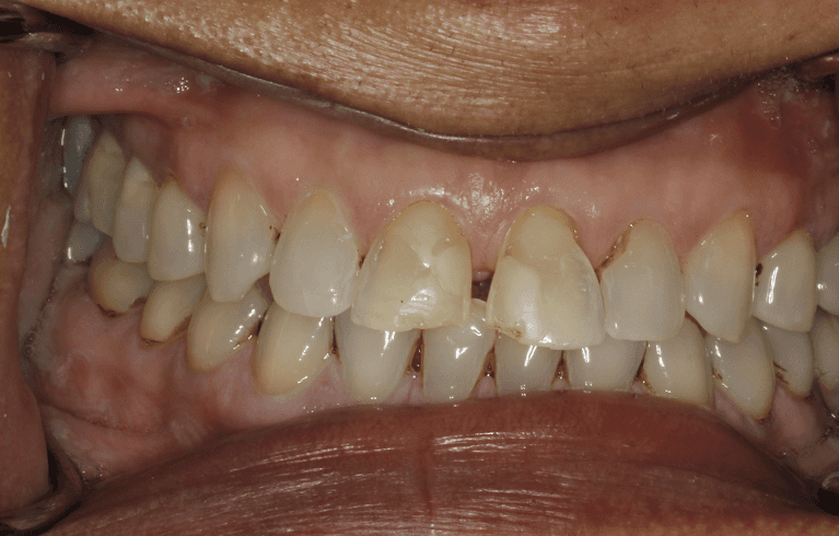 Womans full mouth before veneers, huntsville al