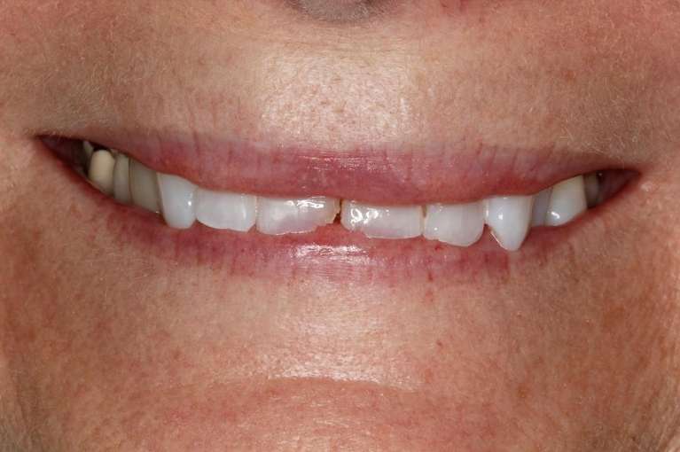Close up of older womens mouth before veneers, huntsville al