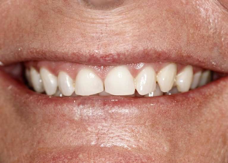 Close up of full mouth before veneers, huntsville al
