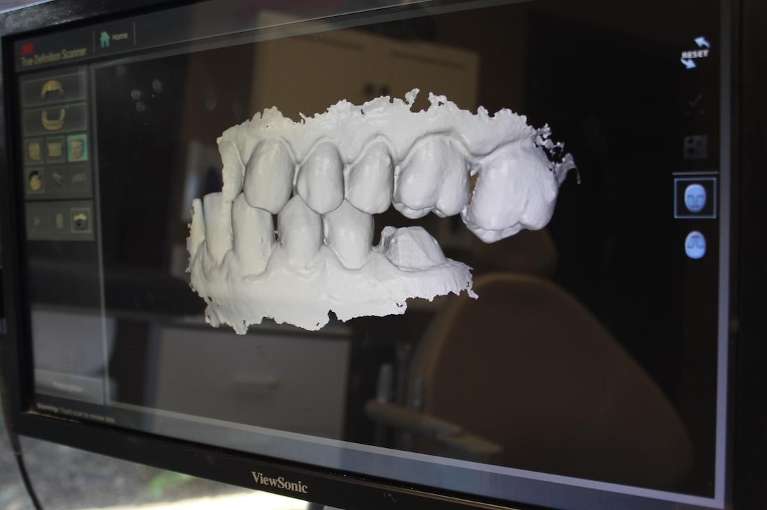 Digital Impressions at twickenham family dentistry in Huntsville, AL